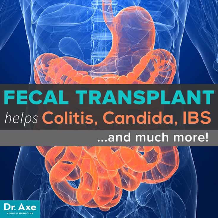 Fekal transplantation för ulcerös kolit, candida, och ibs.